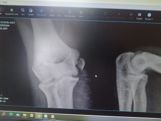 Медицина сынған пенис